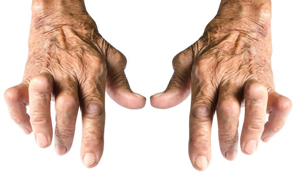 What is arthritis?