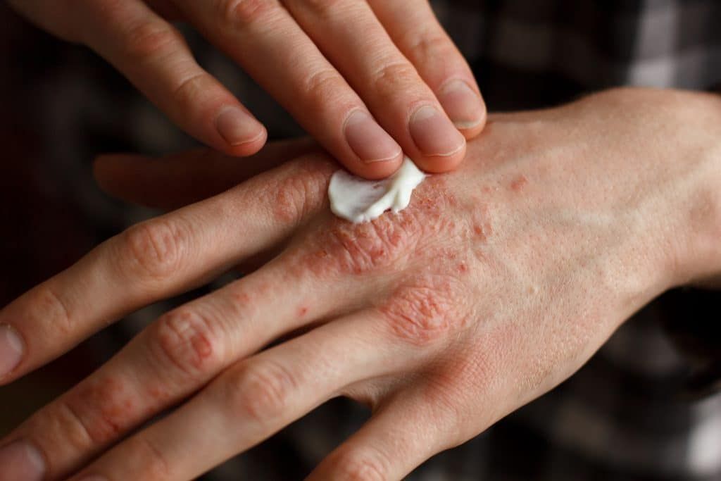 Should I use moisturizing cream?